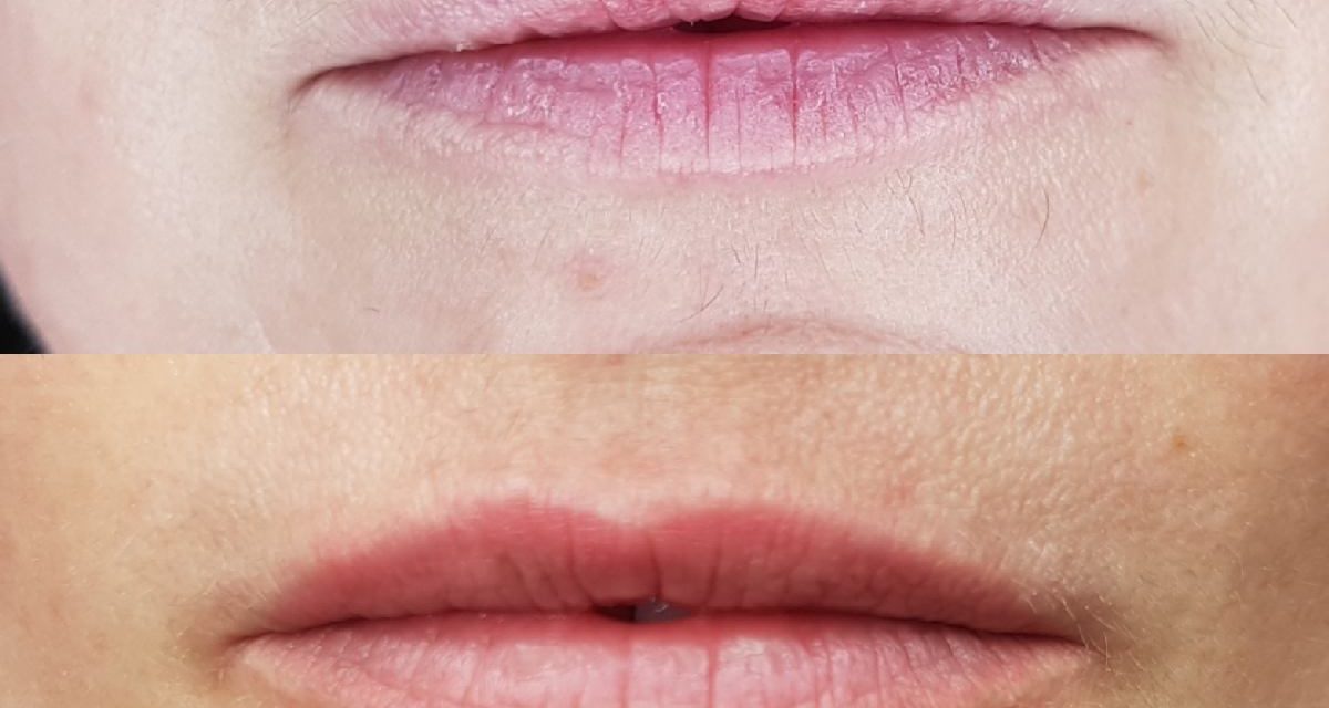 Maquillage permanent bouche « Candy lips ». Cliente de Villefranche.