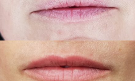 Maquillage permanent bouche “Candy lips”. Cliente de Villefranche.
